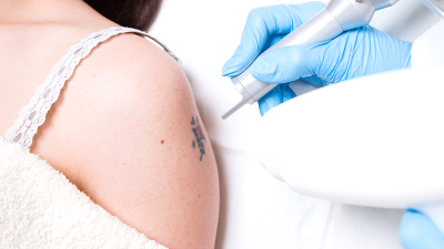 Tattoo Laser Removal - Small